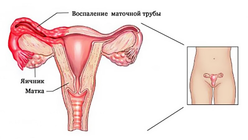Фото:Матка и аднексит: до и после лечения