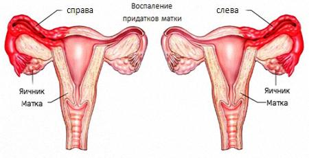 Фото:Хронический двухсторонний аднексит