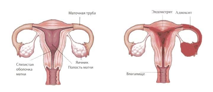 Фото: Аднексит и эндометрит